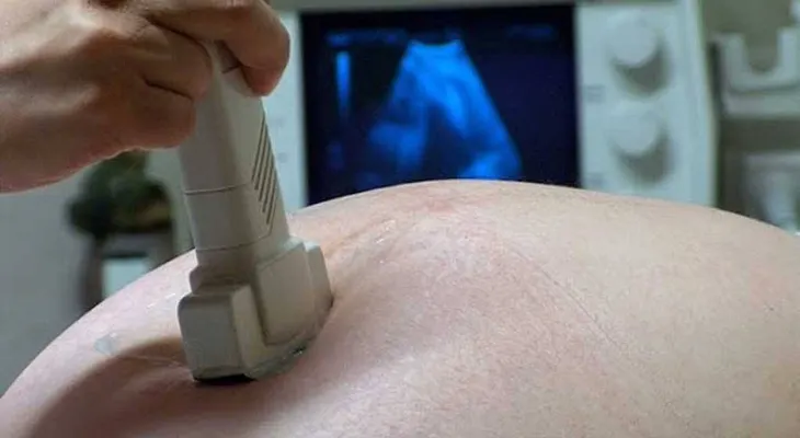 Practican cesárea a doctora padeció Guillian Barré