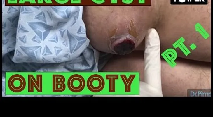 IMAGENES FUERTES: Doctor elimina un grano enorme de la espalda de un chico (VIDEO)