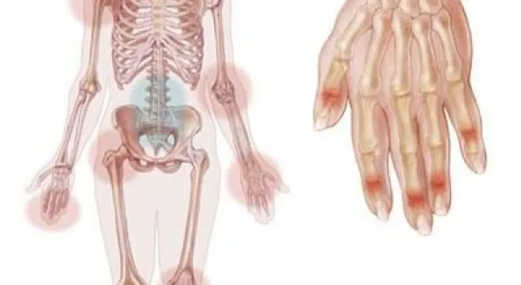 Inflamación causada por la psoriasis puede afectar las articulaciones