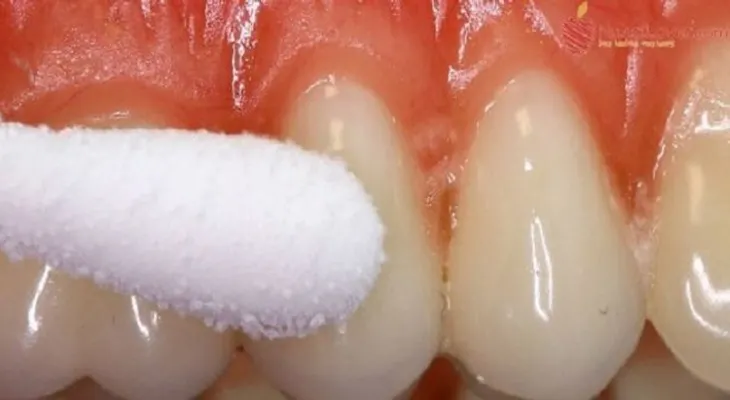 Elimina el dolor de muelas en 1 minuto con este remedio casero!!!