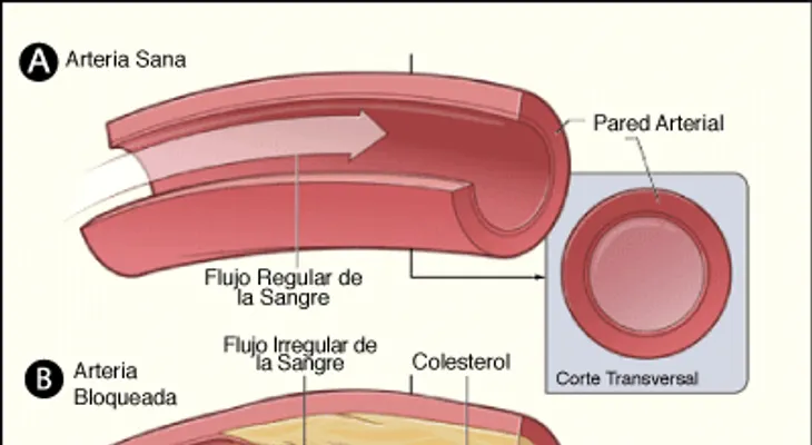 La importancia de bajar el colesterol