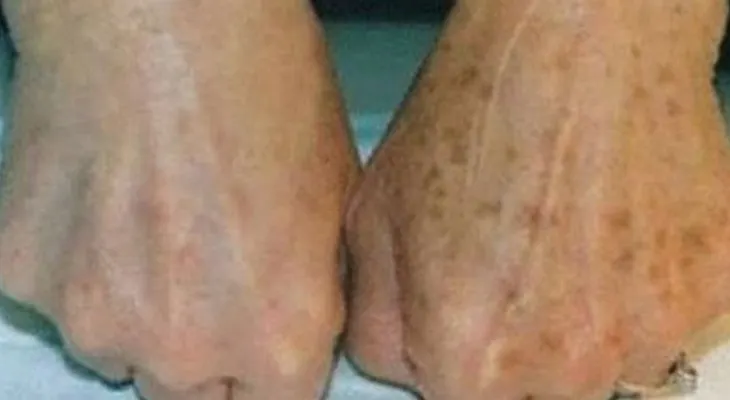 Tiembla la industria de los cosméticos con esta crema casera para quitar las manchas!