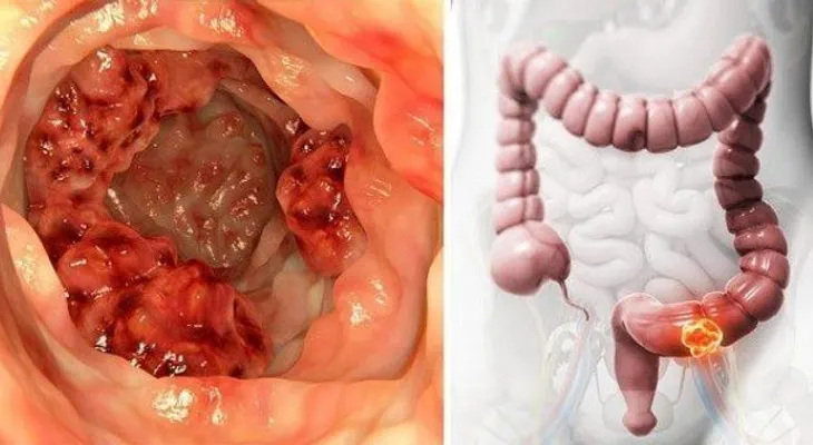 Científicos comprueban que este aceite destruye el 90% células del cáncer de colon en 3 días...