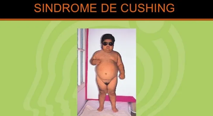 No confunda obesidad con enfermedad de Cushing