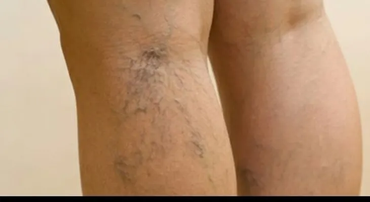 Remedios Imperdibles para eliminar las varices 