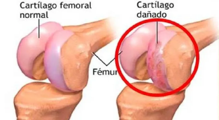 Mi esposo regeneró sus cartilagos dañados con estos 3 alimentos (VIDEO