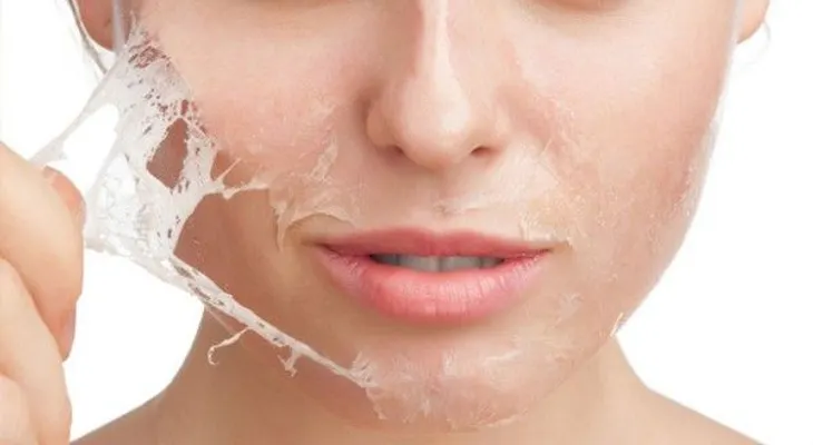 ¿Qué es el peeling químico?