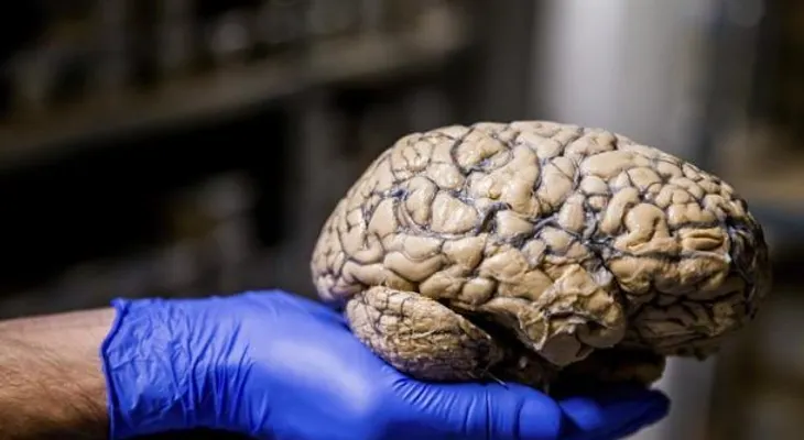  Líquido de tejido cerebral muerto después de un ataque es tóxico y dañino 