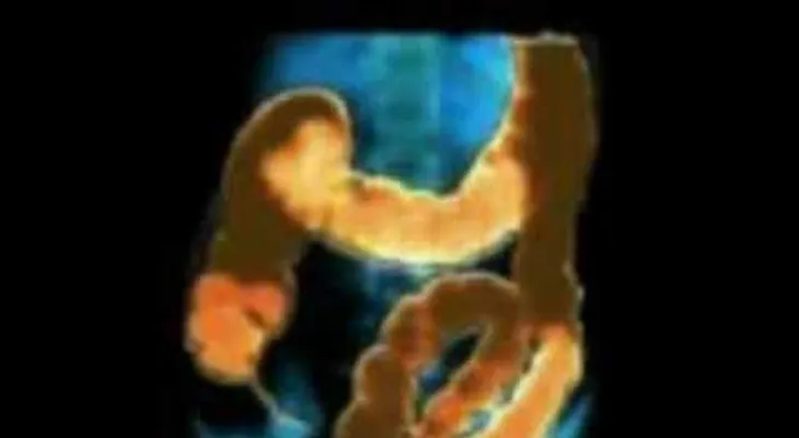 Una limpieza intestinal 100% comprobada 
