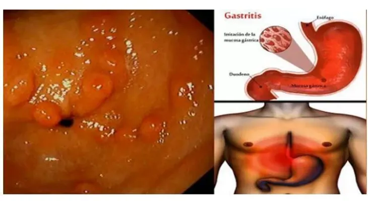 Con este efectivo remedio elimina la gastritis de por vida 