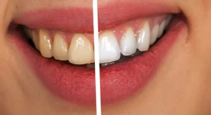 Efectiva alternativa casera para blanquear los dientes
