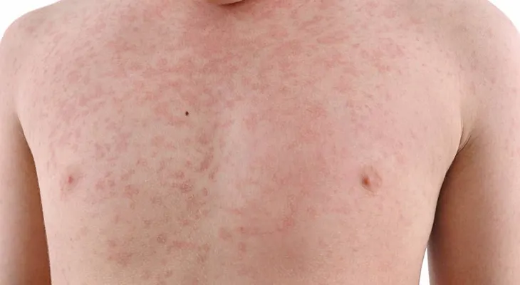 Nueva York declara "emergencia pública" por epidemia de sarampión en Brooklyn