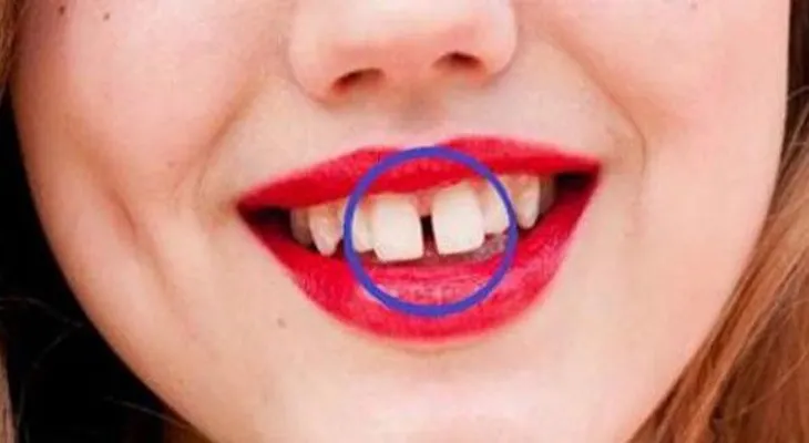 Si tienes o conoce a alguien con dientes separados, tiene que leer esto URGENTEMENTE!!