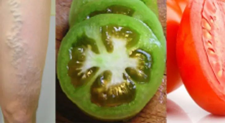 Increíble! Con un tomate puede curar las venas varicosas