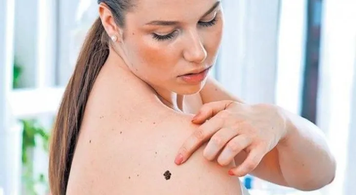 El ABCDE del cáncer de piel