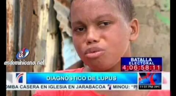 Joven que lucha contra el lupus (VIDEO)