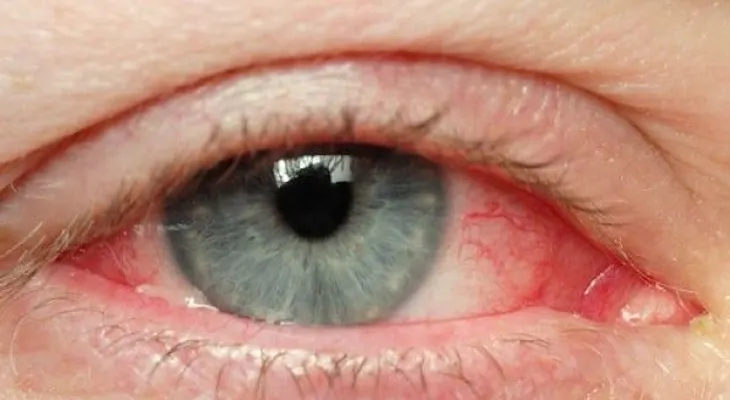 Tips naturales para tratar los ojos irritados