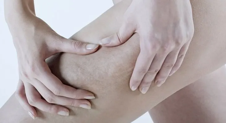 Beneficios del vinagre de manzana para tratar la celulitis