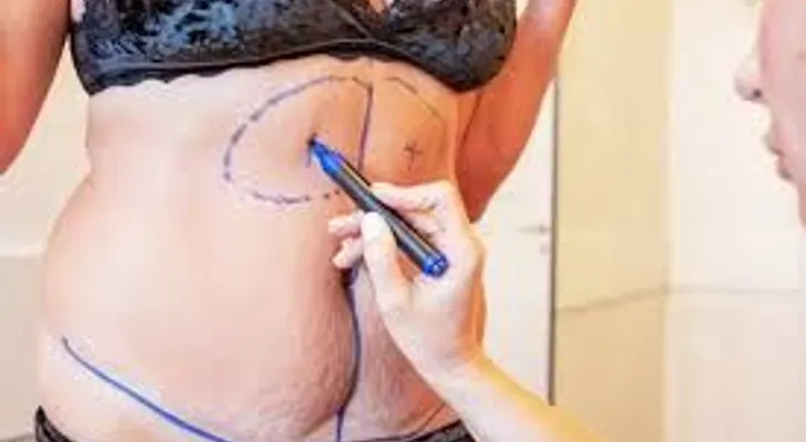 Liposucción: Riesgos y complicaciones