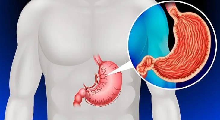 Carne procesada podría incrementar el riesgo de cáncer en el estómago