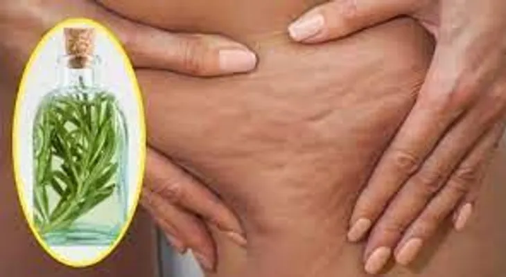 Alcohol de romero para acabar con la celulitis, varices, la gota y dolores musculares!!