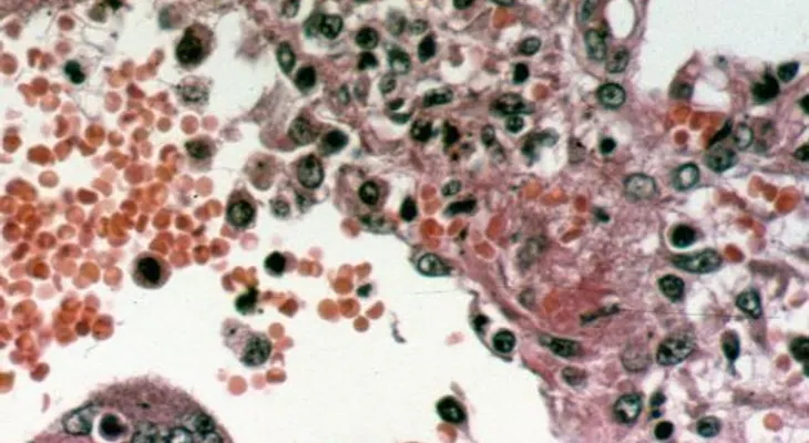 Un virus que no tiene cura ha causado decenas de muertos 