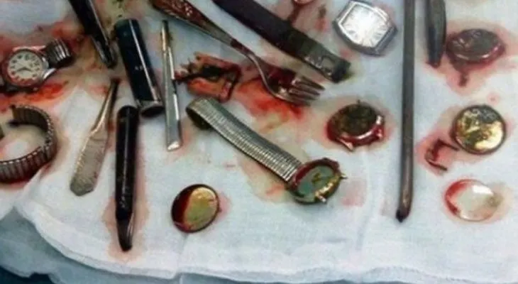 Acorralado por la Policía, un delincuente se "comió" seis relojes, un tenedor, una cuchara, un corta uñas y otros bienes que había robado