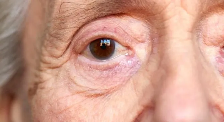 Relacionan el alzhéimer con tres enfermedades de los ojos