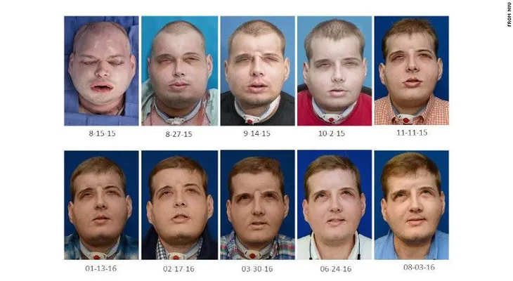 Bombero describe su vida tras trasplante de cara: "ahora tengo esperanza"