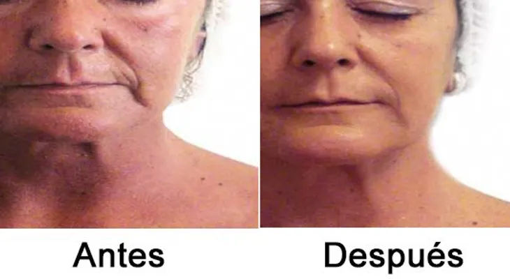 Tratamiento con plaquetas para rejuvenecer