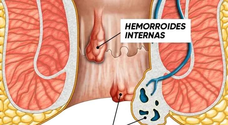Pomada e infusiones para las hemorroides