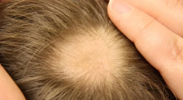 Terminar con la alopecia areata naturalmente