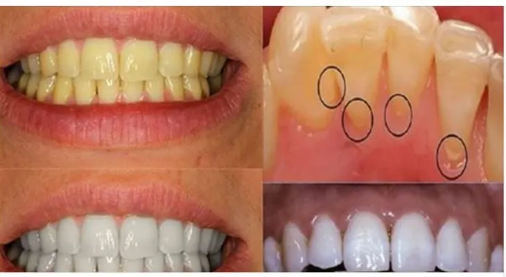 Aplica vinagre de manzana en tus dientes.¡Esto es lo que sucederá! 
