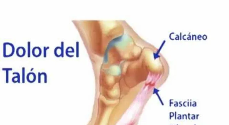 Dolor en los talones y su tratamiento natural