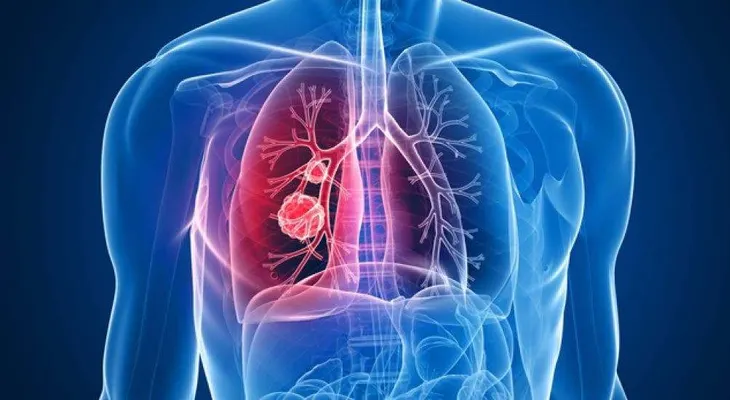 El 90 % de pacientes con cáncer de pulmón mueren debido a la detección tardía