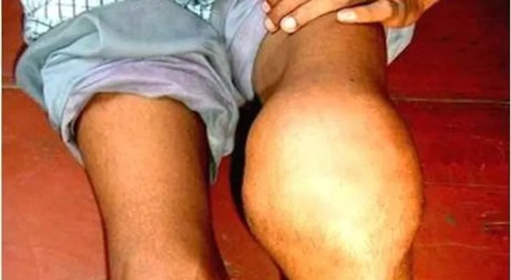 Daños articulares y hemorragias severas son padecidos por pacientes con hemofilia