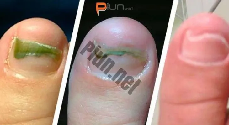 Elimina cualquier hongo de las uñas sin la necesidad de medicamentos solo aplicando esto