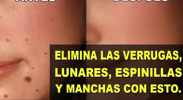 Esta sencilla receta casera elimina verrugas, lunares, espinillas y manchas de tu cuerpo 