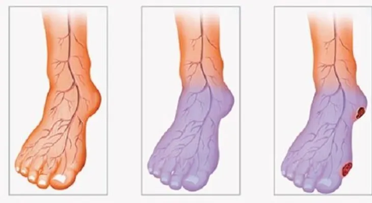 ¿Problemas de circulación de la sangre, frío en las piernas y las manos? esto es lo que debes hacer para controlarlo