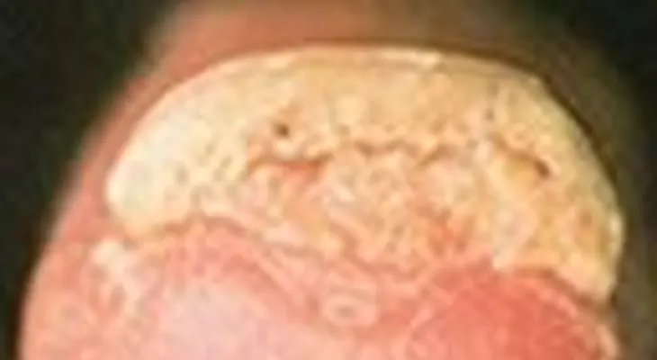 Enfermedades, Patologías y Problemas de las uñas