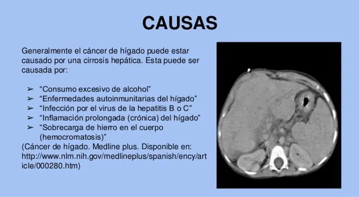 Advierten cáncer que produce consumo de alcohol 