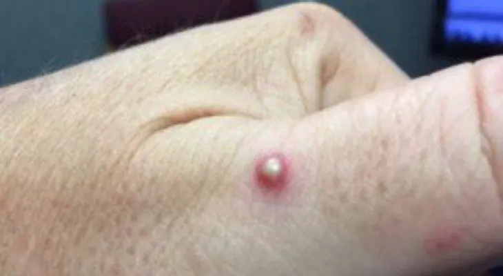Cómo identificar las 8 picaduras más comunes que existen