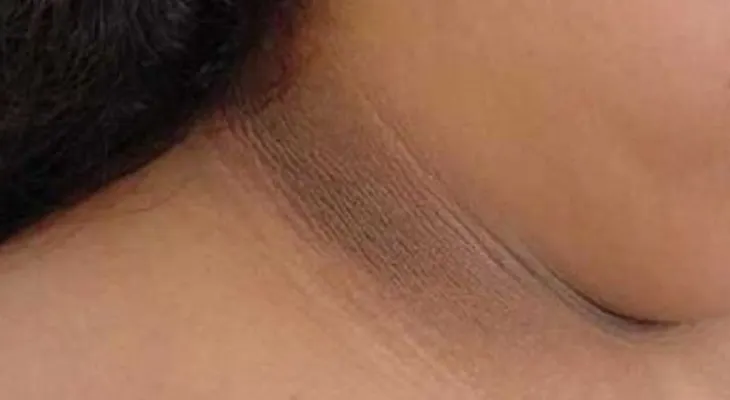 4 formas de quitar el cuello oscuro