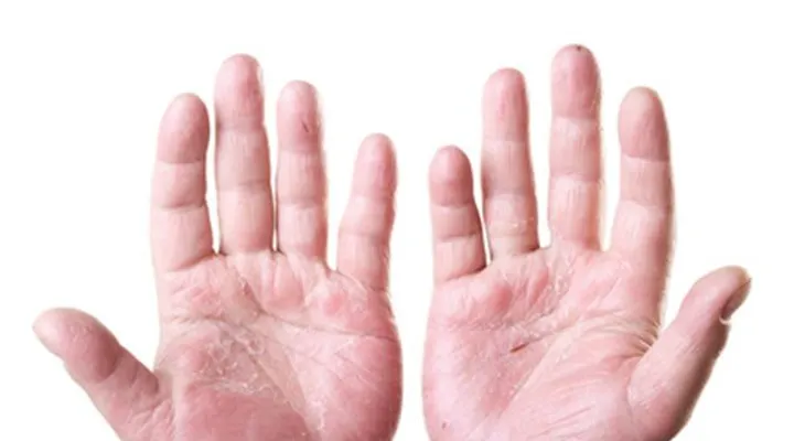 180 millones de personas padecen Psoriasis