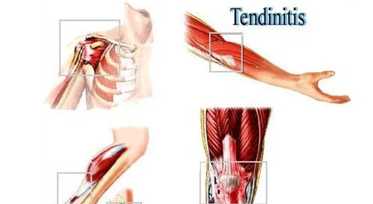 La tendinitis; causas y tratamientos