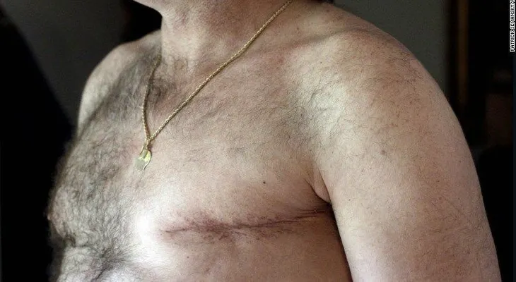 Aumentan las mastectomías dobles en hombres con cáncer de mama