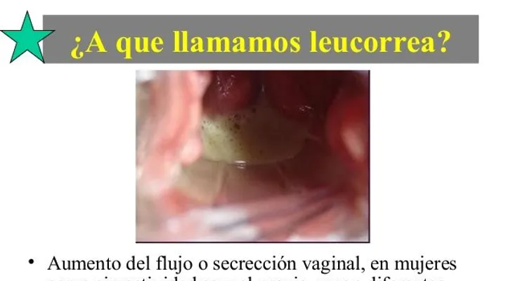 Una mujer con leucorrea puede tener una secreción vaginal pegajosa: Síntomas y tratamiento