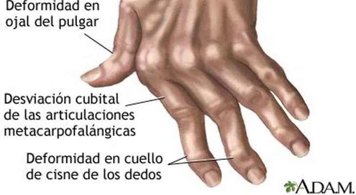 Con este te que tiene en tu CASA cura la artritis, la fibromialgia y las infecciones de garganta 
