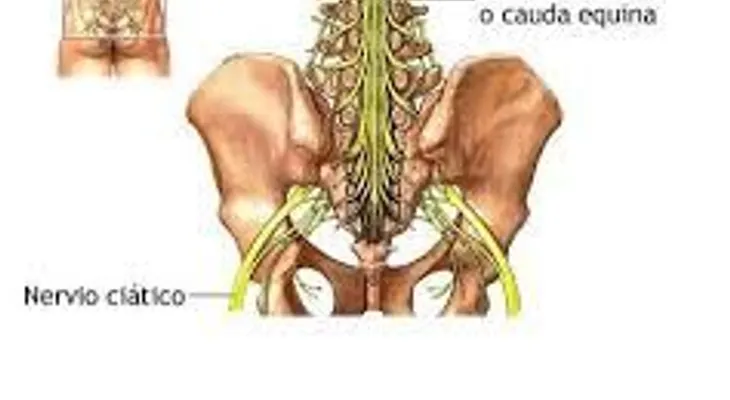 El tratamiento médico para un nervio ciático