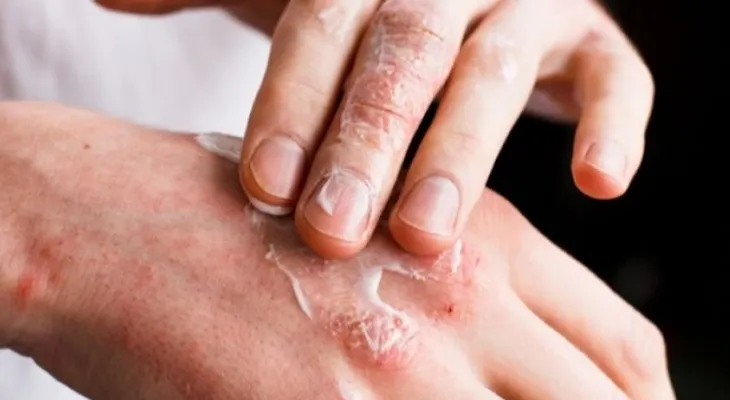 Terapias para tratar la psoriasis de manera efectiva 